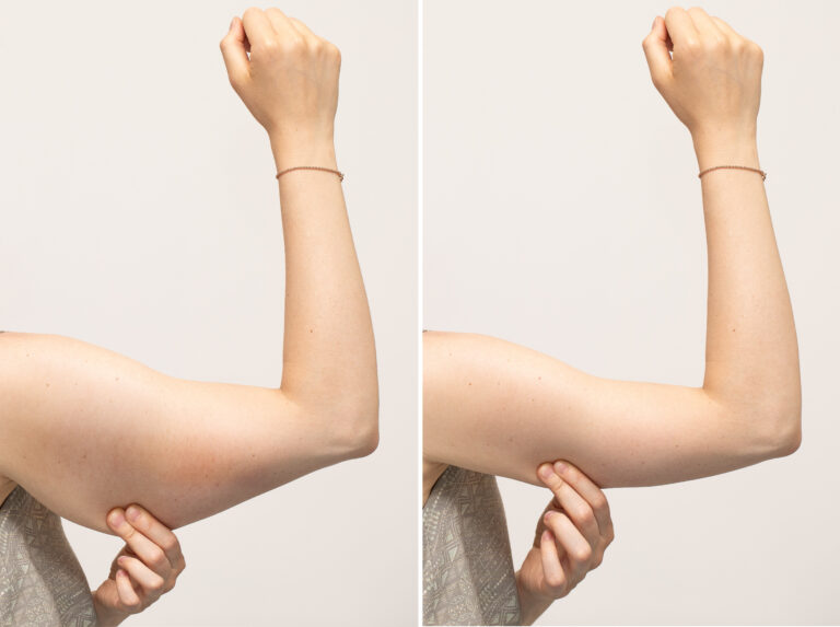 Best At-home Arm Exercises for Flabby Triceps